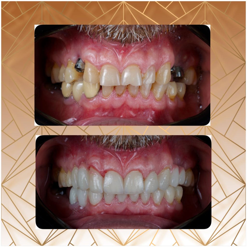 بلیچینگ در سعادت اباد