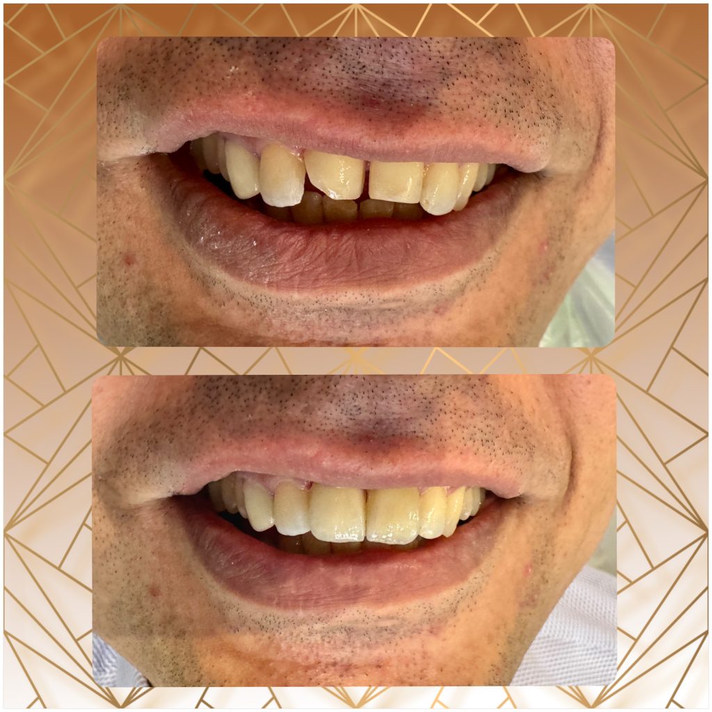بلیچینگ در سعادت اباد